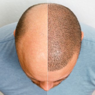 Hair Transplant Treatment in Vadodara before and after results